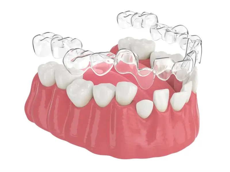 Nakładki ortodontyczne Invisalign