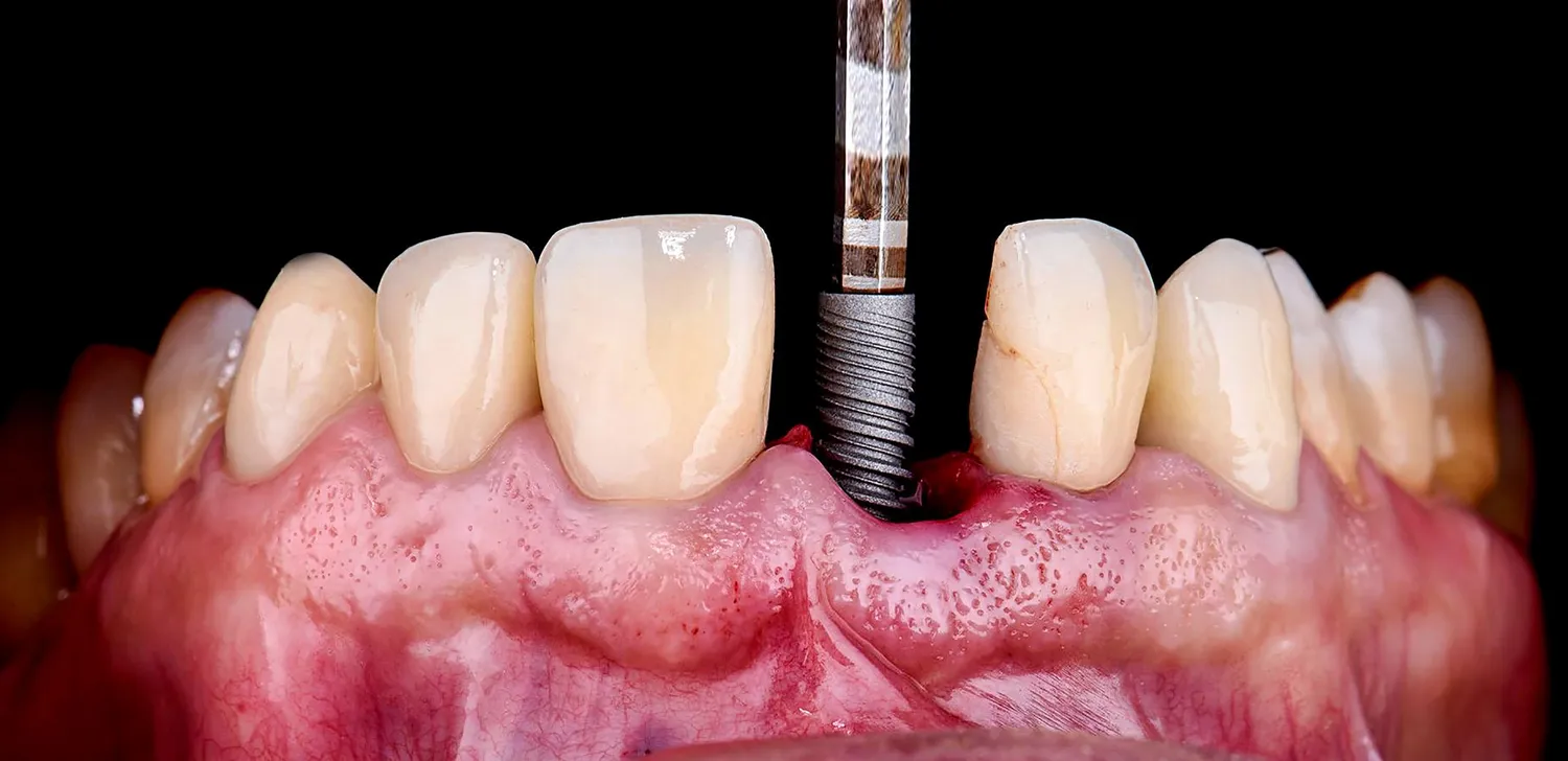 Rodzaje implantów zębowych
