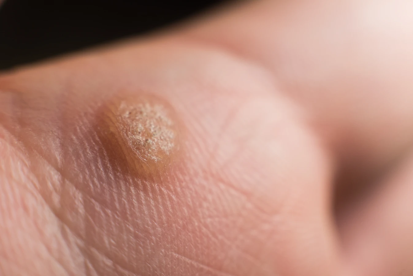 Ile kosztuje usunięcie kurzajki?